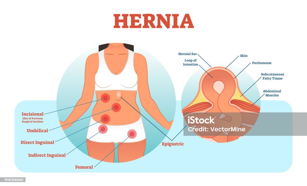 hernia treatment in goregaon