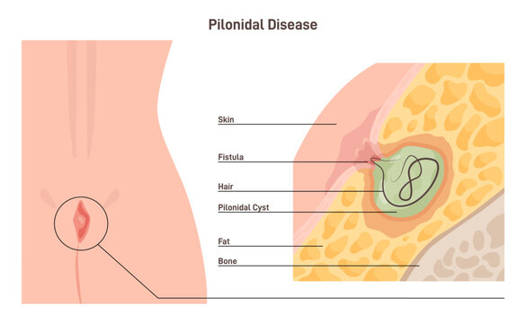 laserpilonidal sinus treatment in goregaon